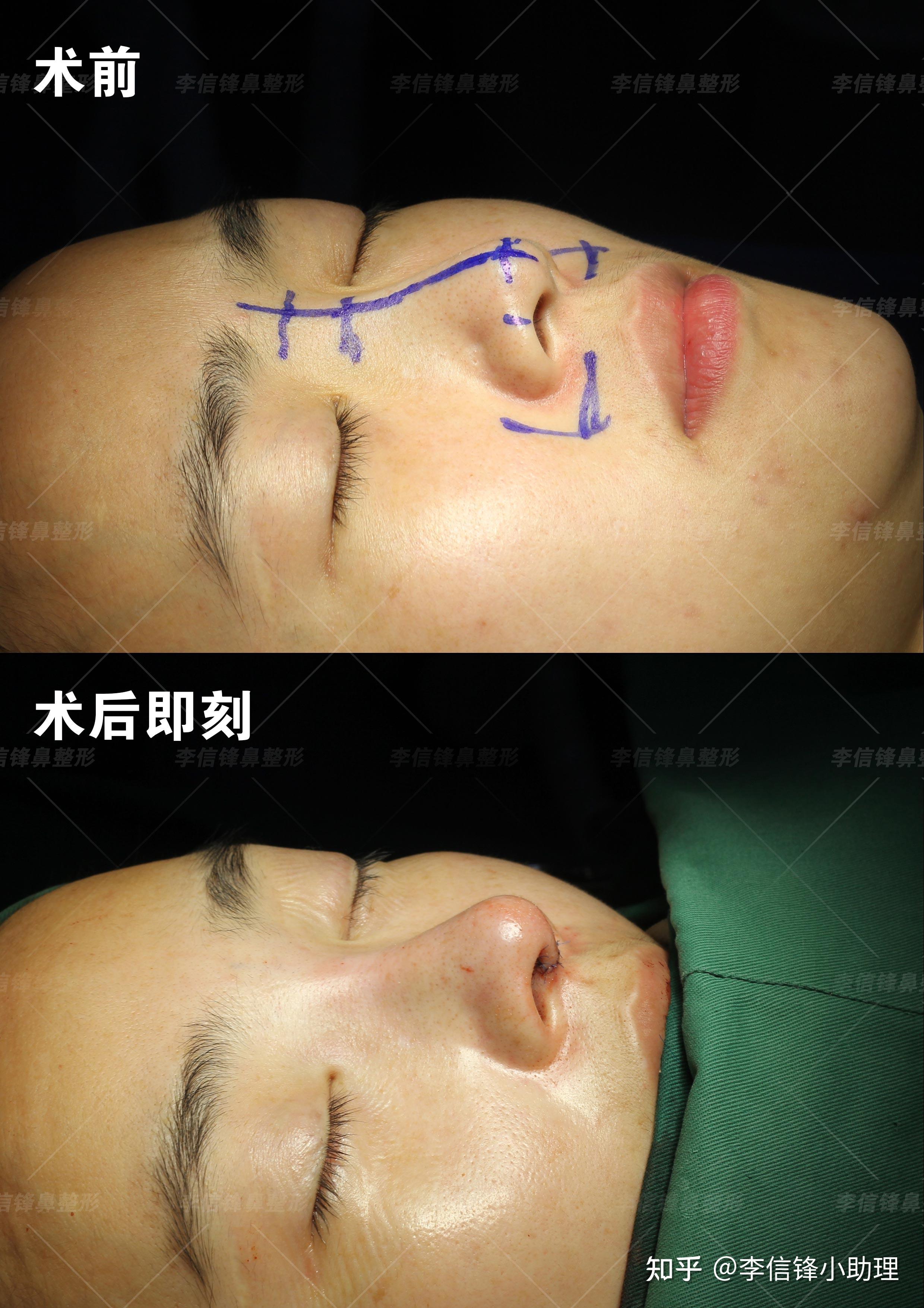 取线雕修复面中部凹陷案例—深圳李信锋隆鼻整形 - 知乎