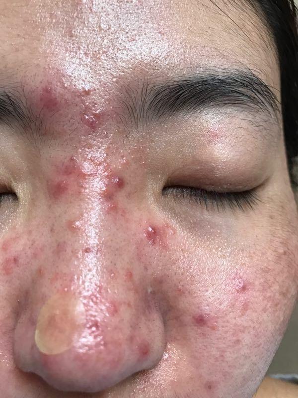 因此当出现激素依赖性皮炎后 ,一定要理性对待. 激素脸防护