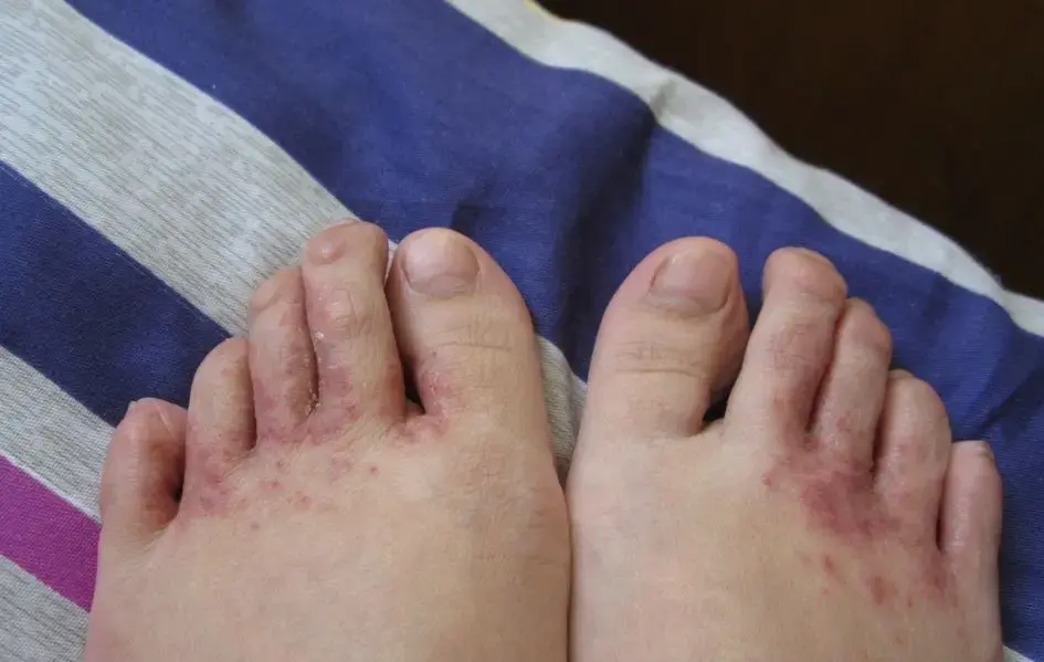 脚气脚气病与脚臭