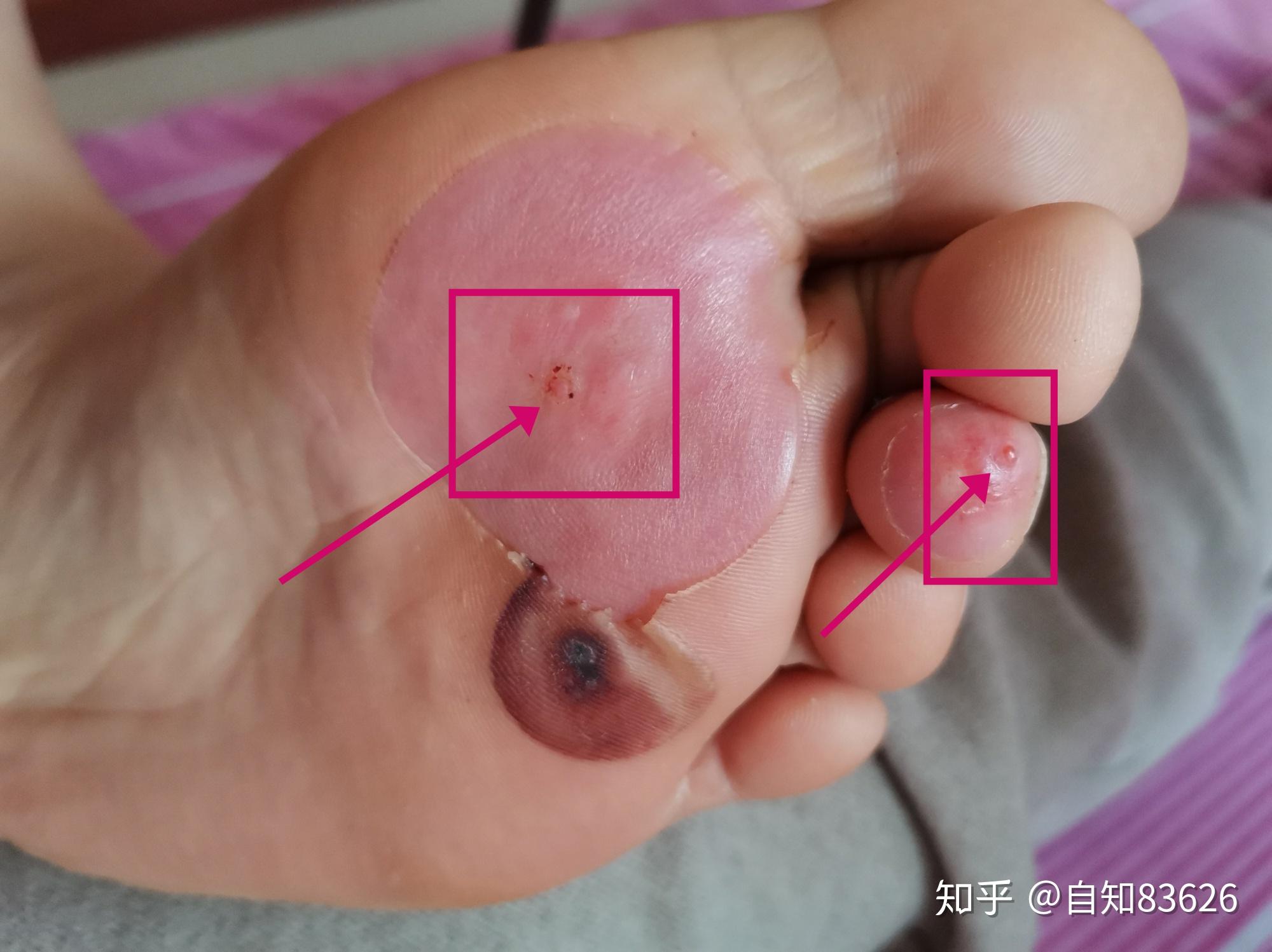 跖疣冷冻后恢复记录
