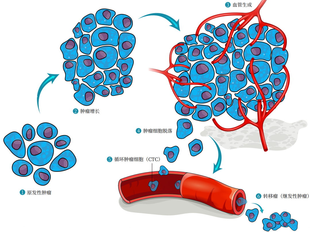 这些癌细胞原本是循环肿瘤细胞,定植后就成了播散肿瘤细胞.