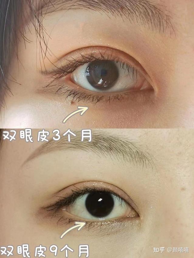 浙江杭州双眼皮医院医生功课妈生眼排名前五测评