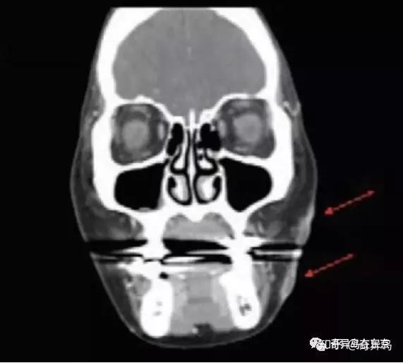 咦,脸上有个线头?线雕出现并发症怎么办| 日本整容整形 - 知乎