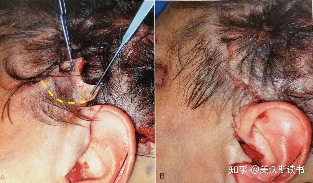 外科医生的签名:手术切口设计 - 知乎