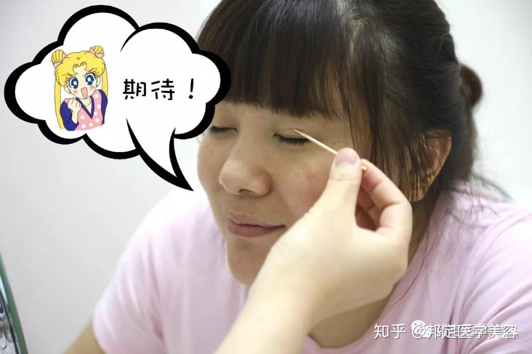 期待~张医生缓缓的靠近,用一根小小的牙签轻划我的眼皮.