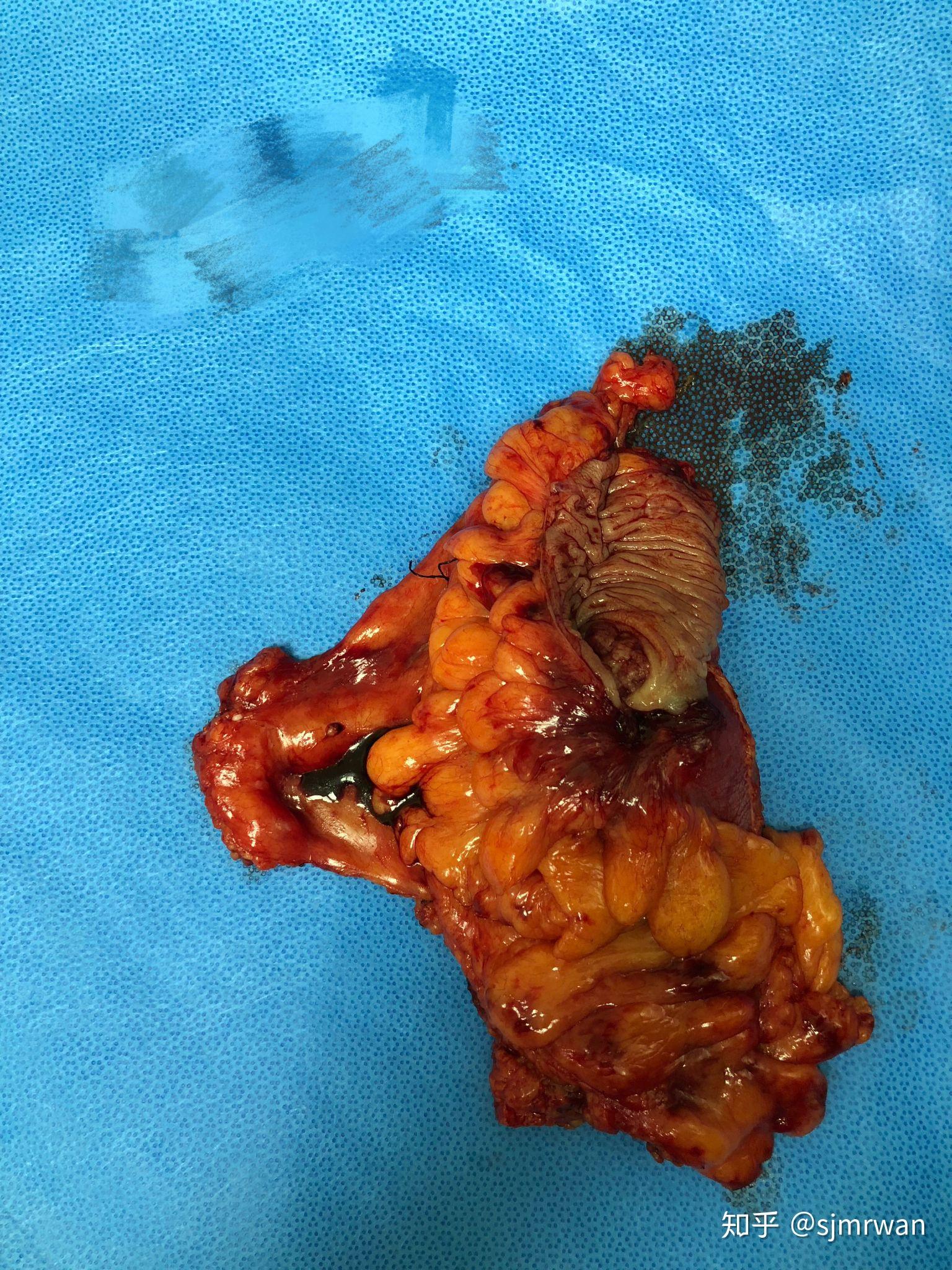 降结肠肿瘤图片