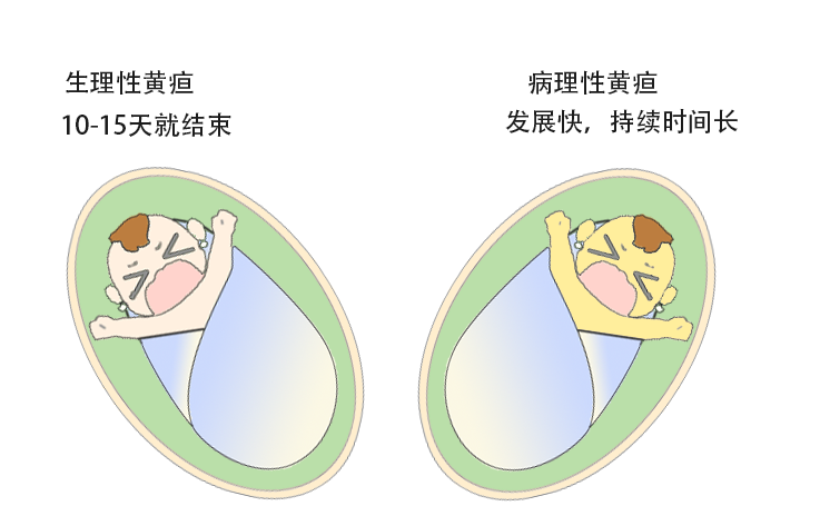 病理性黄疸照片图片