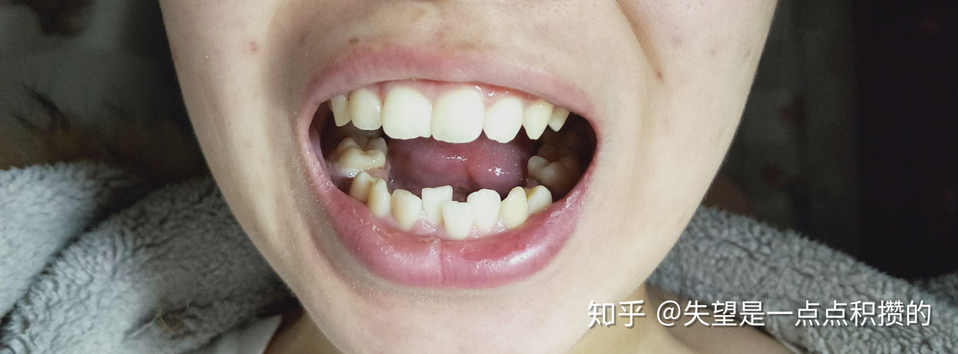 桂林正畸 | 龅牙 牙齿拥挤 - 知乎