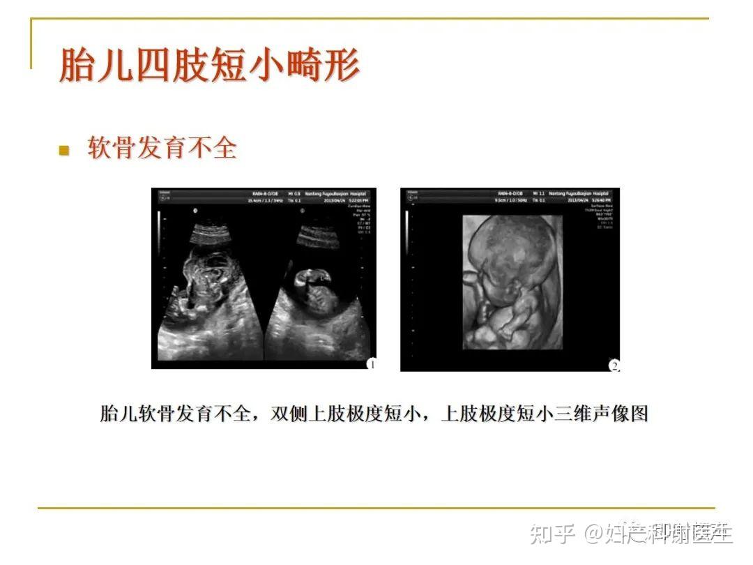 胎儿肢体畸形：超声图表现如何解读和诊断？早发现早处理！ - 知乎