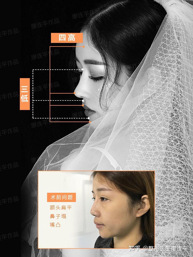 鼻子审美(六)-鼻部与面部的美学关系 - 知乎
