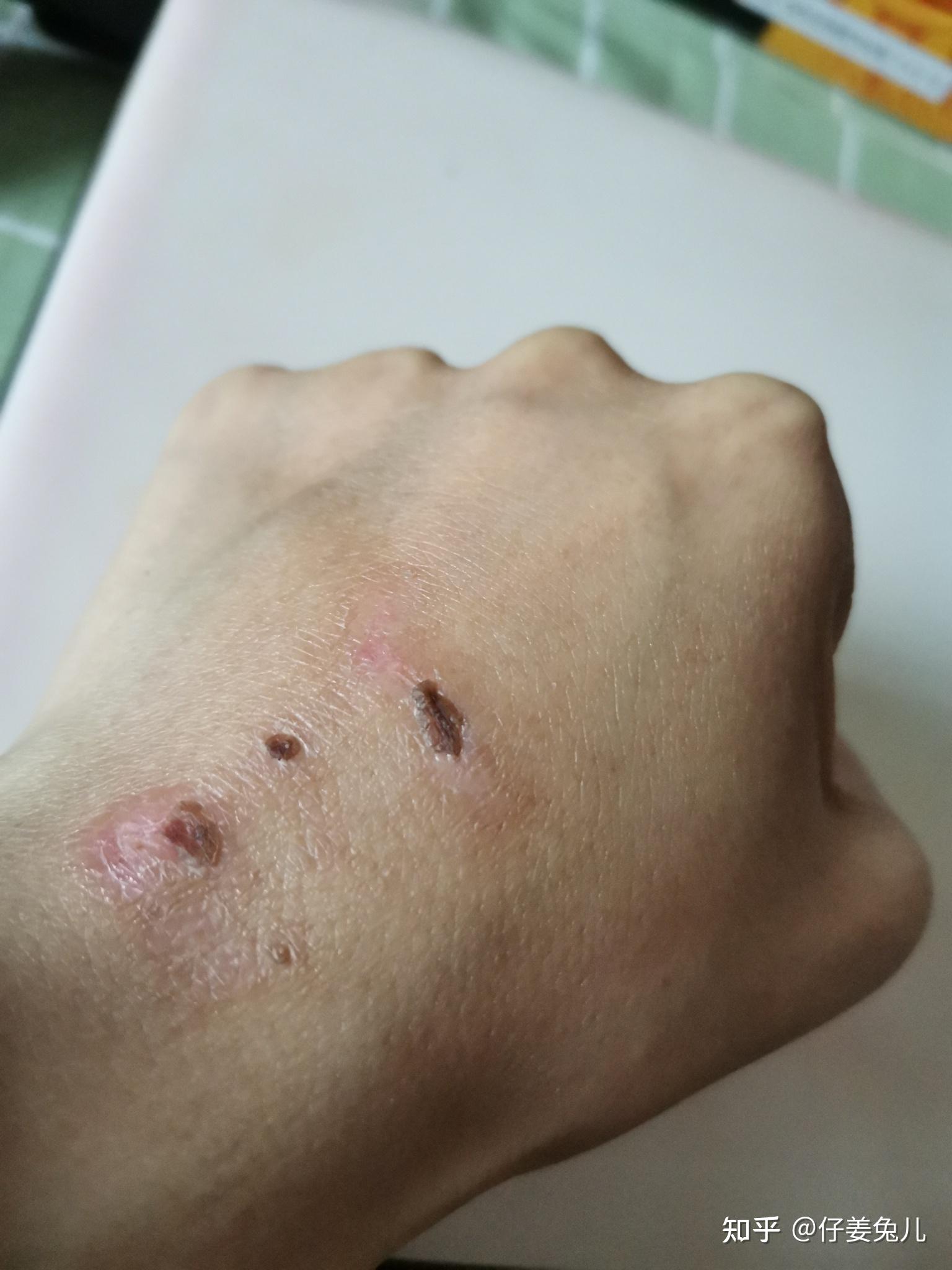 暖水袋烫伤恢复日记