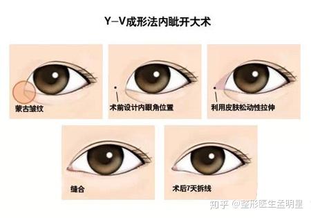 开内眼角好还是开外眼角好？