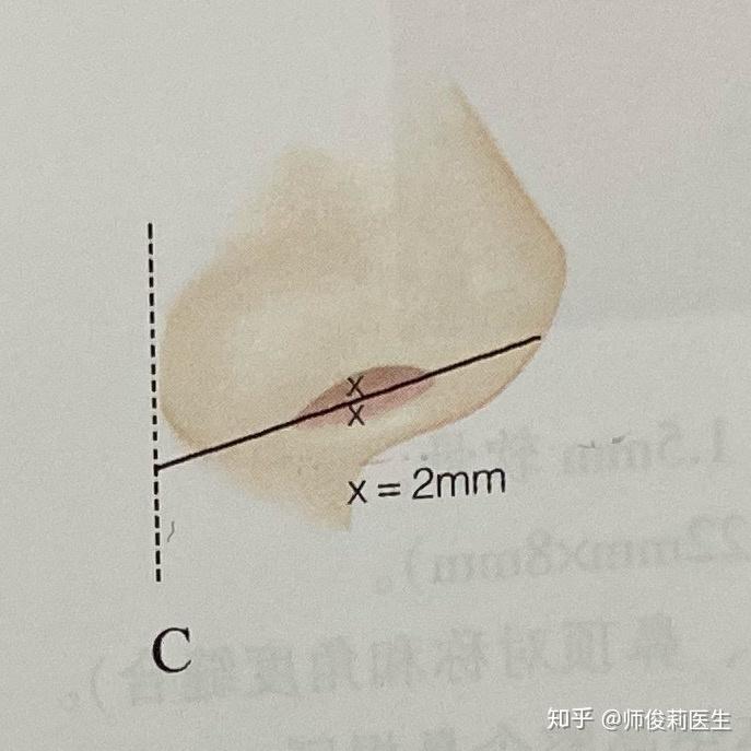 你究竟是鼻翼缘退缩还是正常鼻孔暴露