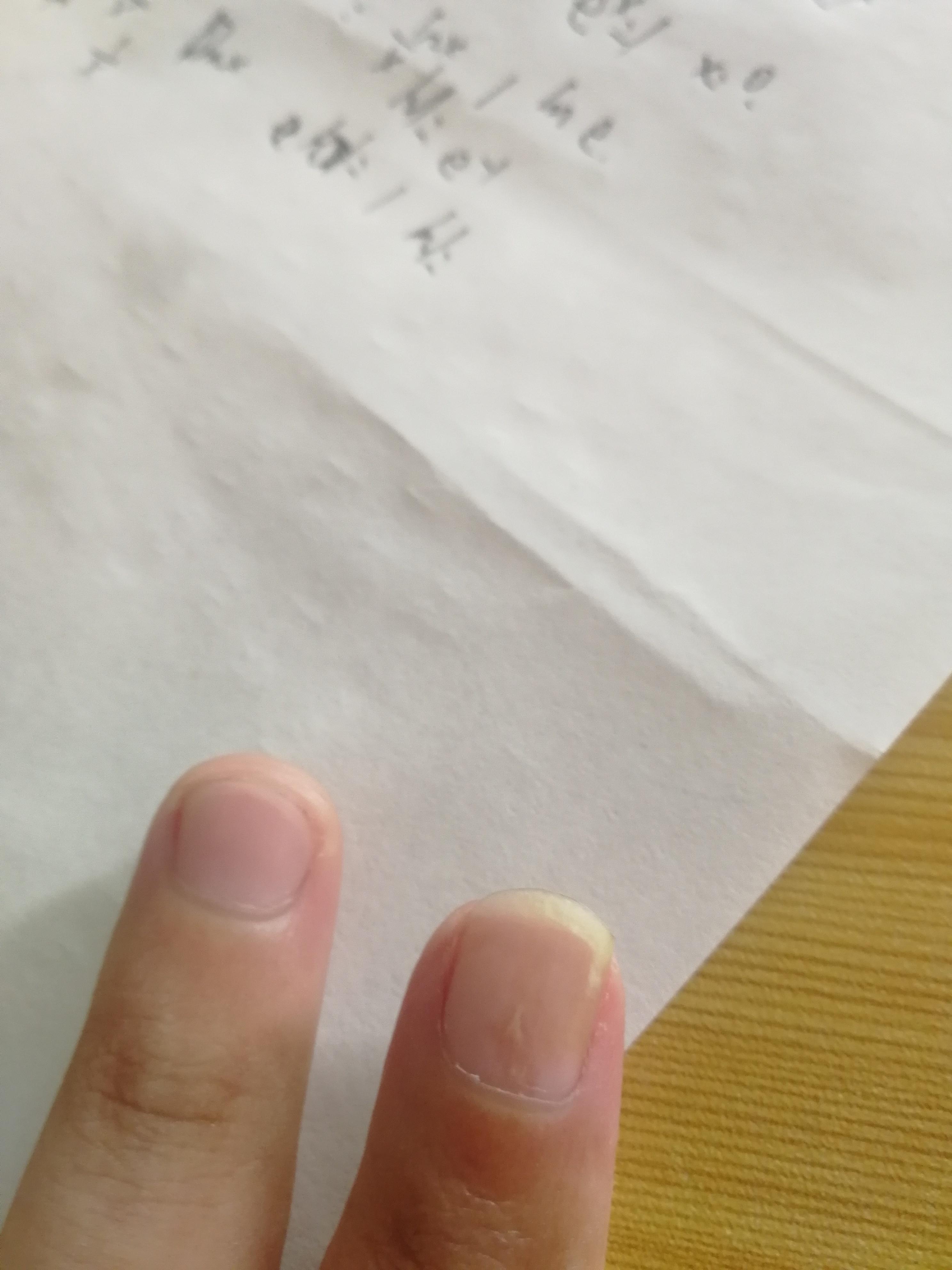黃景昱醫師的皮膚小學堂: 我的指甲怎麼裂成兩半了? 認識腸病毒感染引起的脫甲症（Onychomadesis）