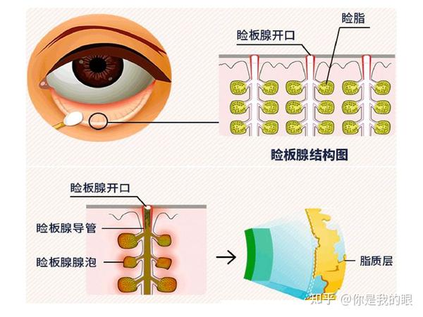 细说干眼——睑板腺堵塞了怎么办？ - 知乎