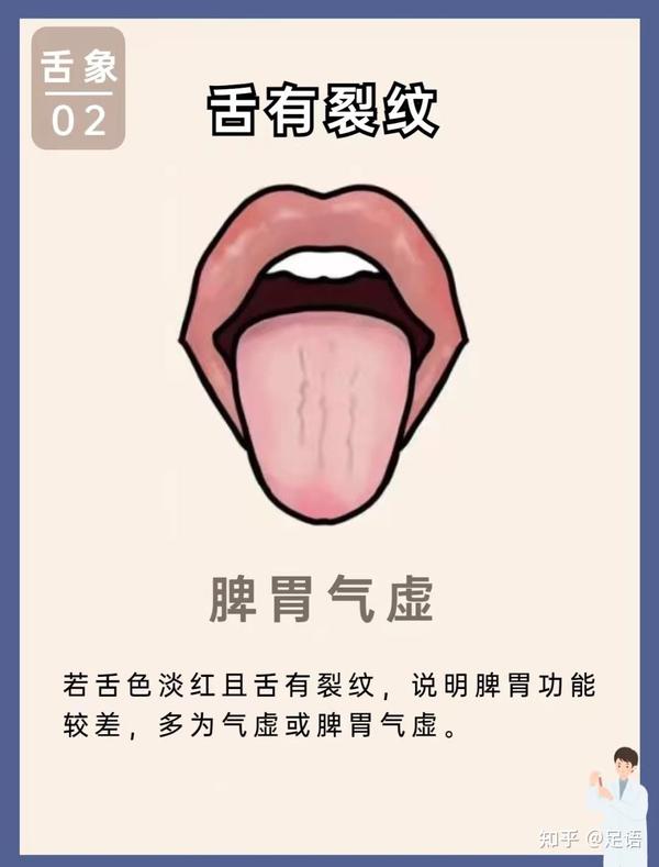 舌有齿痕裂纹，舌苔黄腻淡白，这样做!!! - 知乎