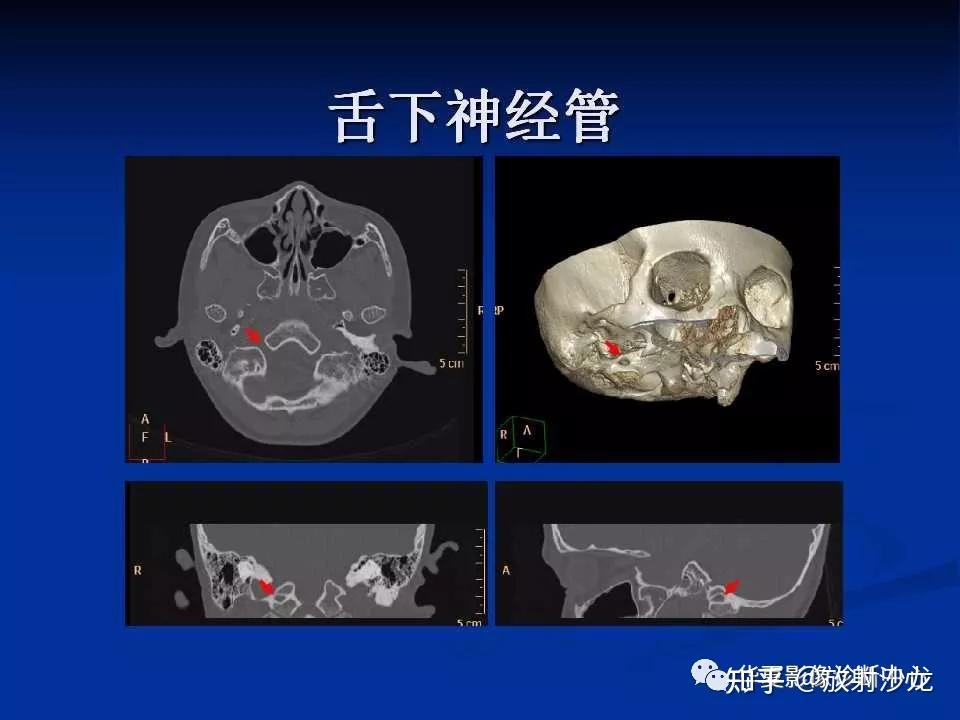 無骨性偽影,多方位成像等特點在顯示正常顱底神經,血管等結構及其病變