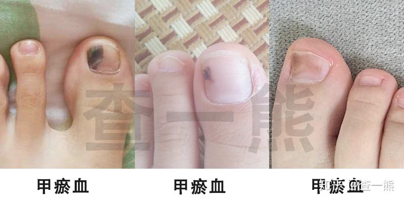 【灰指甲手册】灰指甲你必须知道的那些事