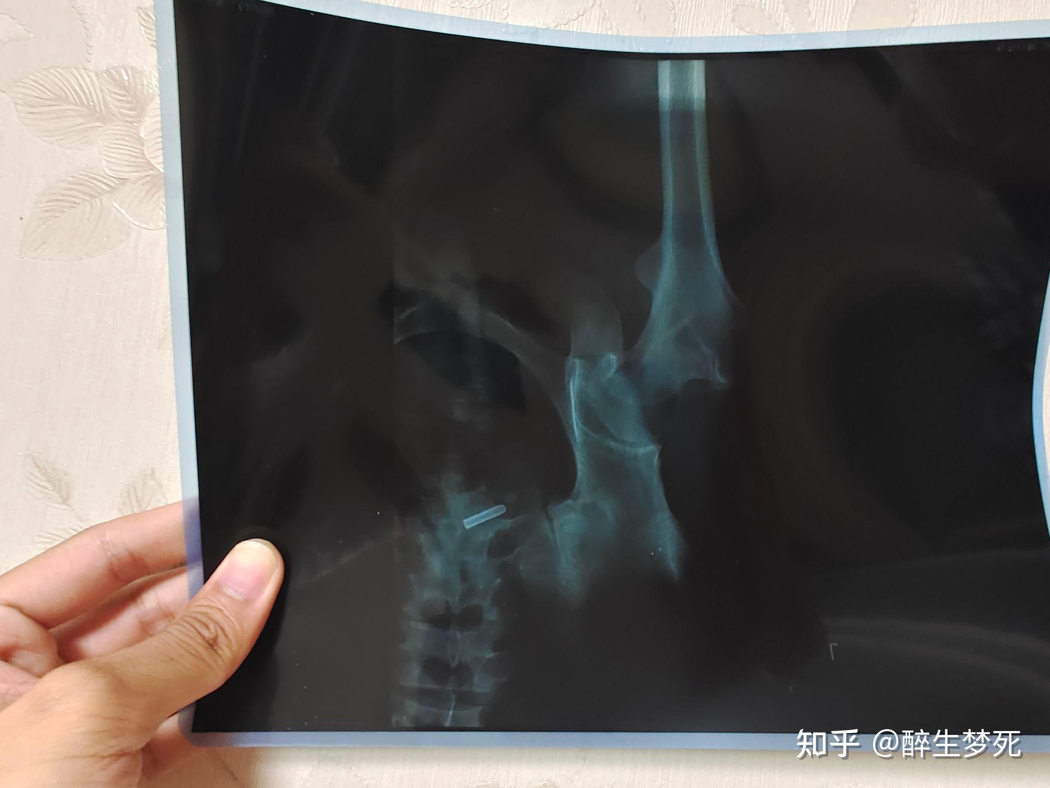 想问髋关节X光片中这个像子弹一样形状东西是什么呀 - 知乎