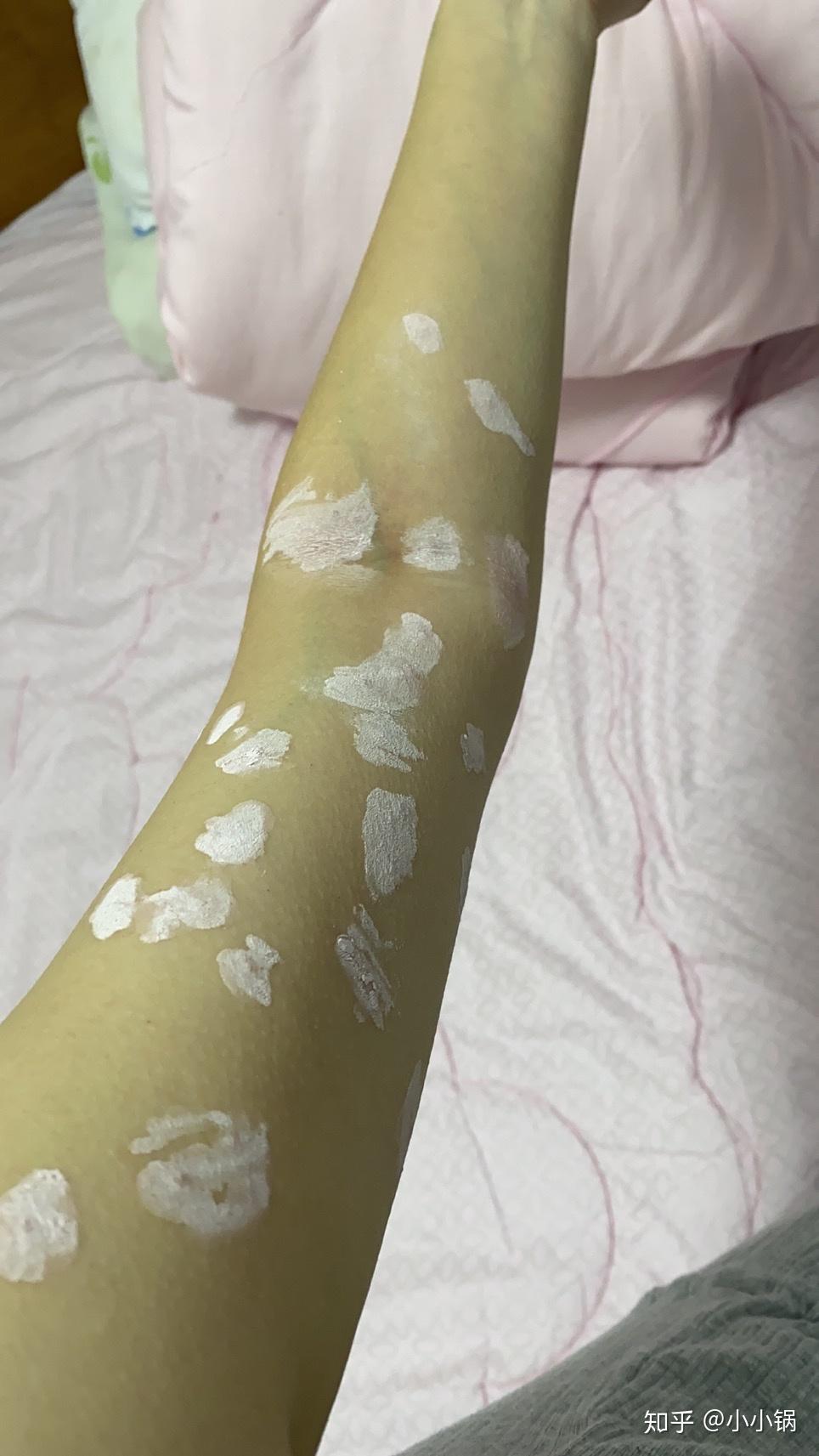 养猫之后身上起小红点是什么?怎么办? - 知乎