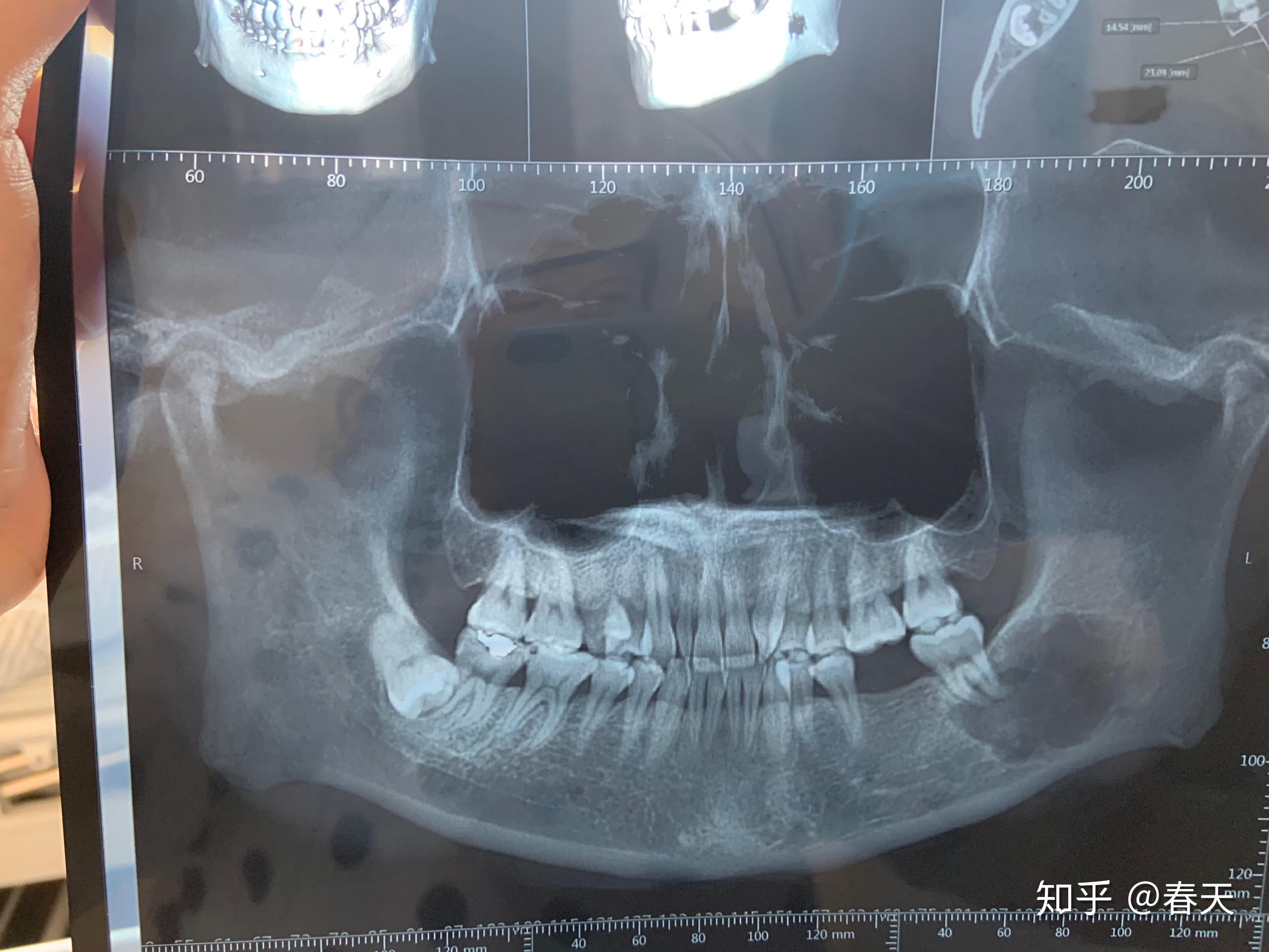 上颌骨ct图片