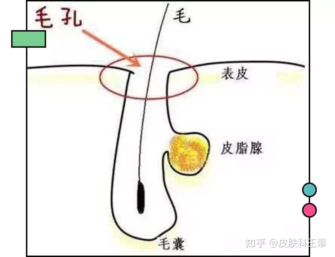 1.皮脂腺分泌旺盛引起的毛孔粗大