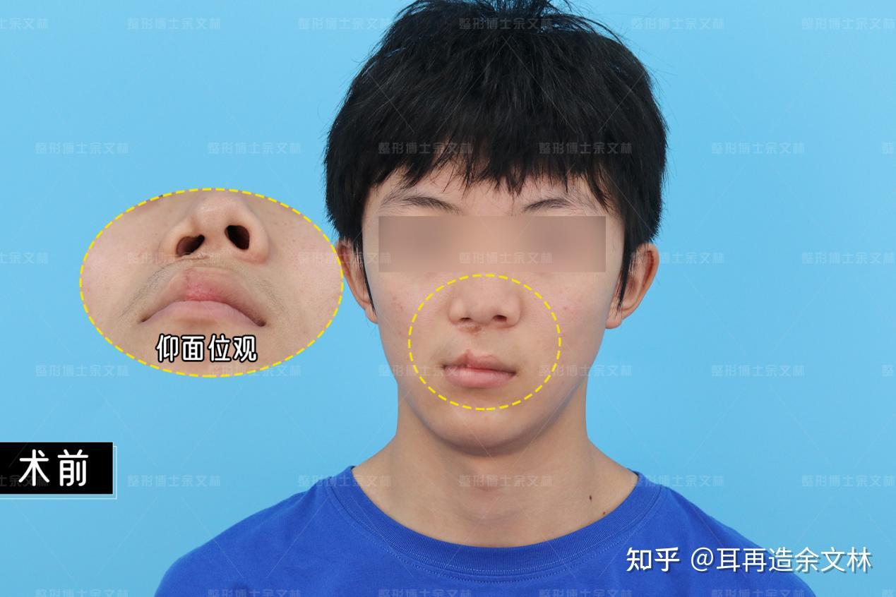 【案例分析】一边鼻孔塌了呼吸都困难!等不及最佳年龄就过来修复了! - 知乎