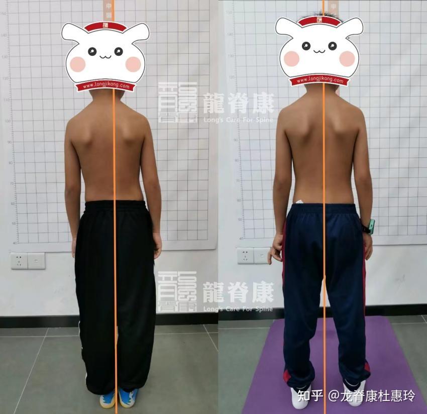 孩子含胸驼背,不良体态,如何通过训练矫正?