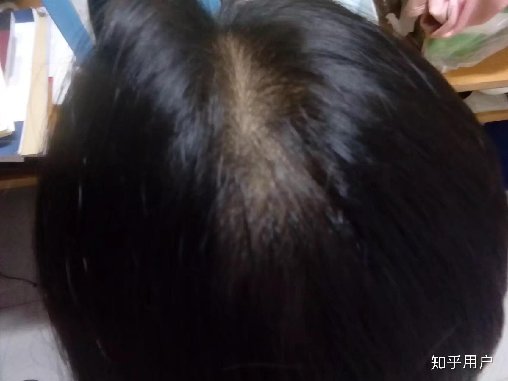 头皮护理新趋势:为头发之源注入活力