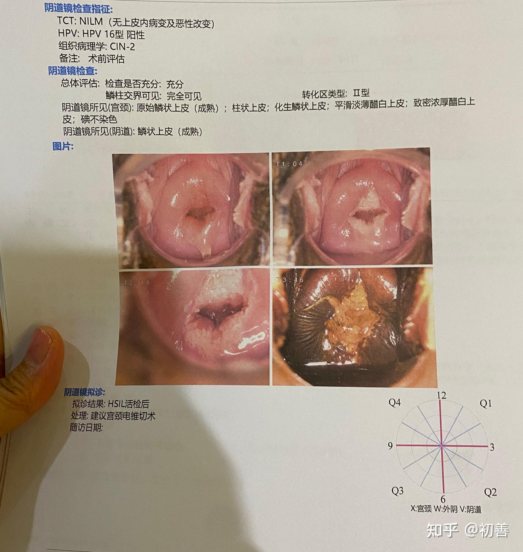 hpv16阳性宫颈cin2级的治疗经历上