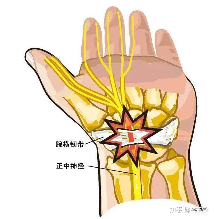 疼痛解剖学|腕管综合征 - 知乎