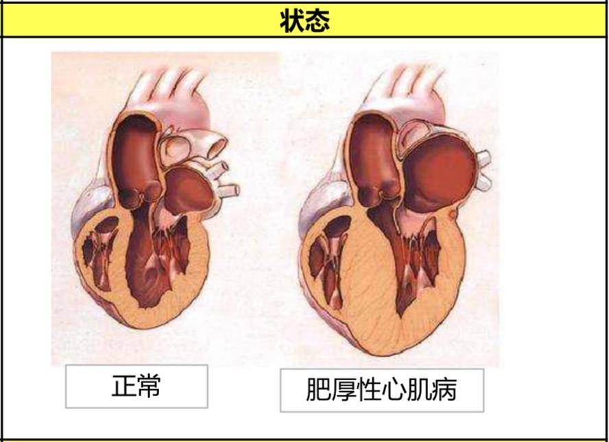 大病理赔严重原发性心肌病