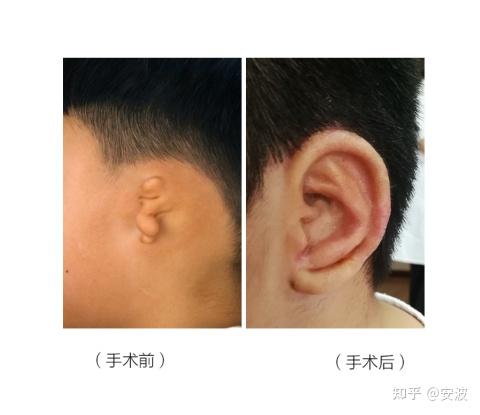 小耳科普十四孩子小耳畸形的多大可以再造耳朵
