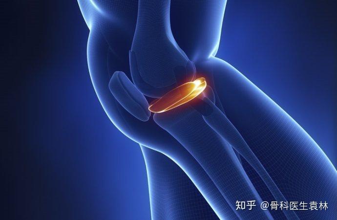 膝关节软骨损伤的原因怎么预防膝关节软骨损伤 知乎