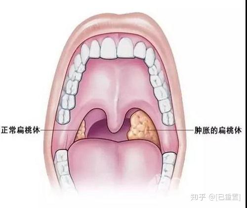 为什么扁桃体肿大的孩子越来越多 润朵堂小儿推拿告诉你 知乎