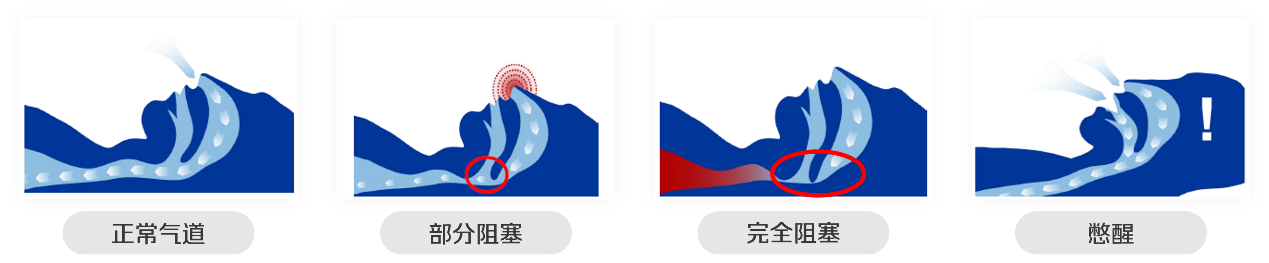 公众人物睡眠打鼾再上热搜,背后的危害和发病率不可小视 - 知乎
