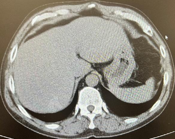 肝脏炎性假瘤需要手术吗