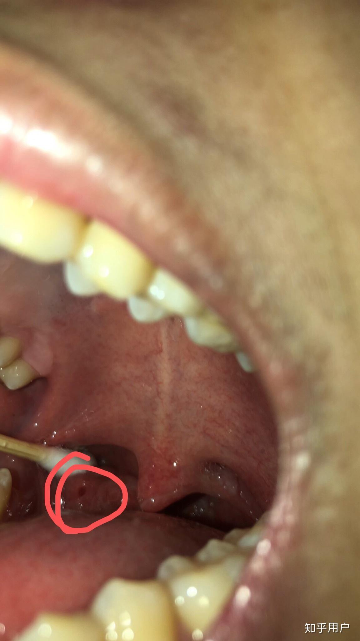 如何清除或者减少喉咙里的黄色颗粒? - 知乎