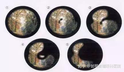 首先,我们先来看一组数据,全世界有900万人因青光眼致盲,我国40岁以上