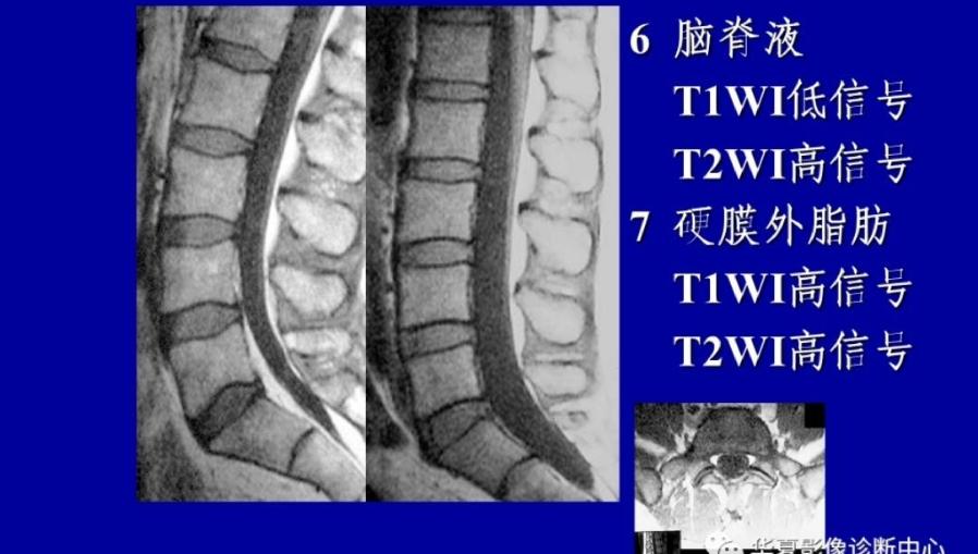 與纖維環分界不清,t2w1:周邊纖維環呈低信號,中央呈高信號);上下終板