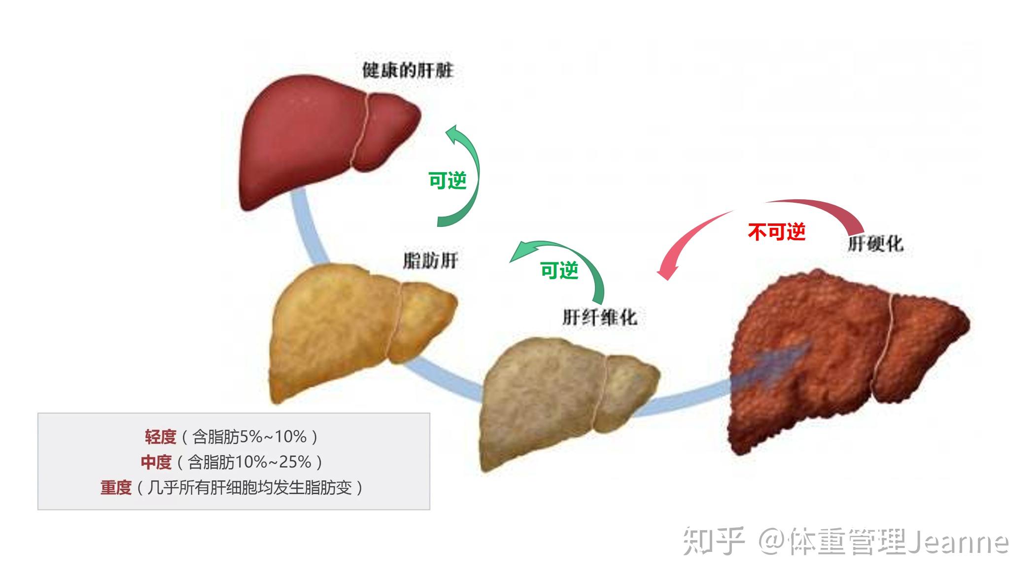 脂肪肝:分期，诊断和治疗beplay官