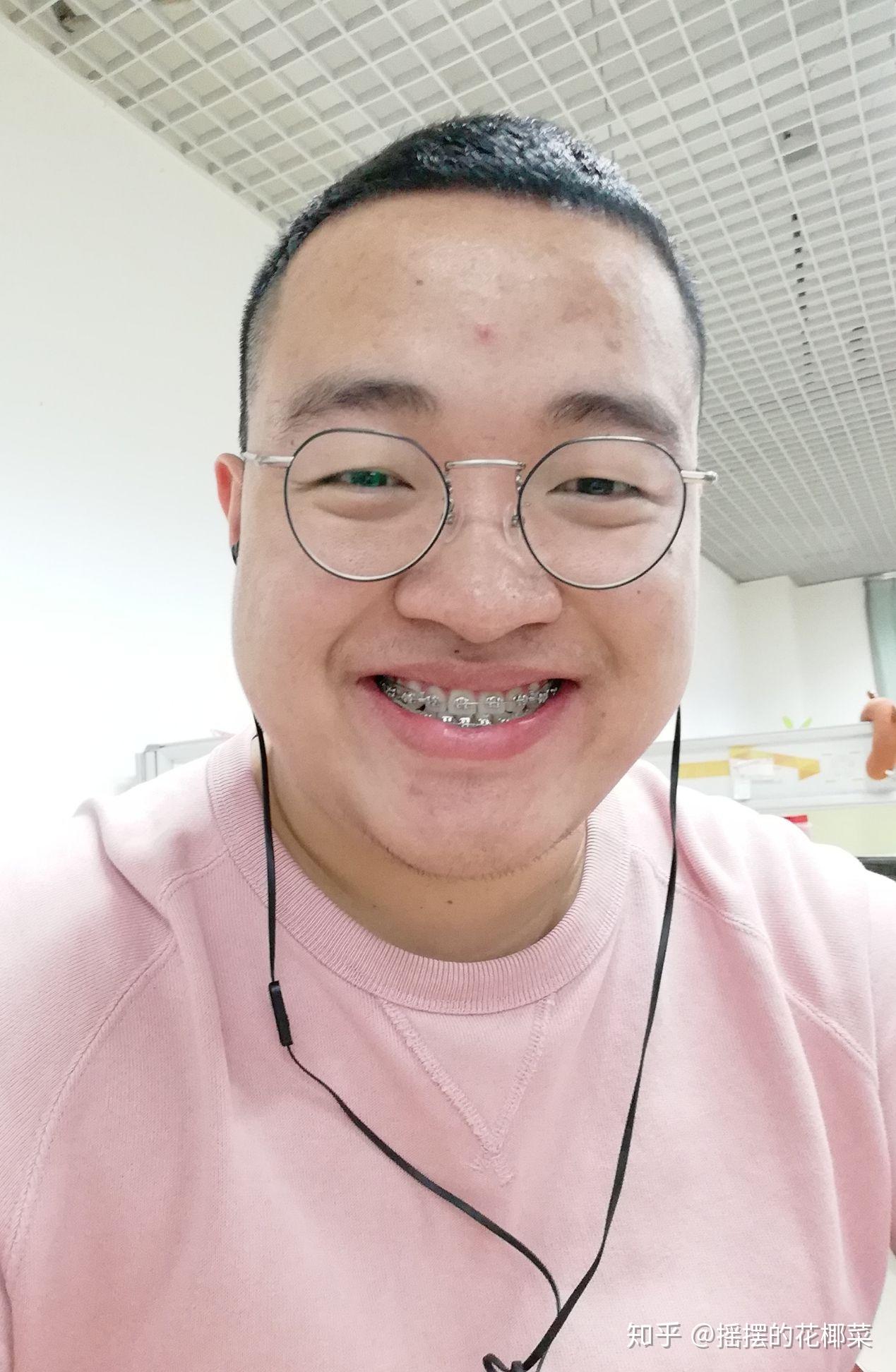 骨性反颌(轻微地包天)-对刃,中线不齐,牙齿缝隙大-26岁男-正畸记录