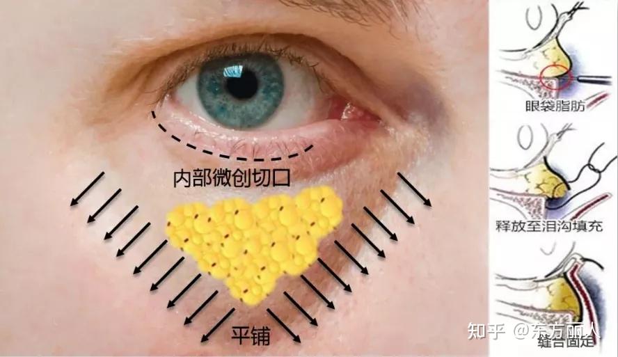 被低估的眶隔释放丨当我们提眼袋，为什么一定要提眶隔释放？ - 知乎