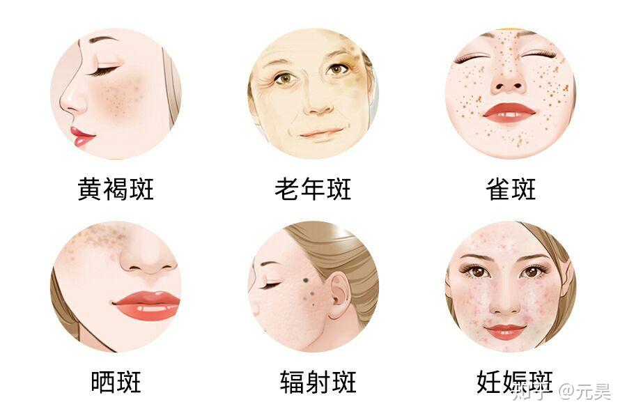 斑的种类 - 知乎