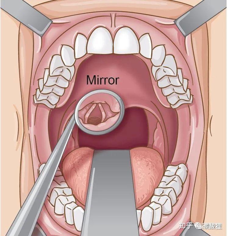 直接喉镜检查 部位图片
