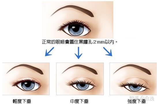 重症肌无力患者再也不用长期服用西药了