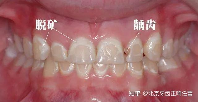 很多牙齿矫正的患者牙面上会呈现白垩色的点或斑块,临床上称为龋白斑
