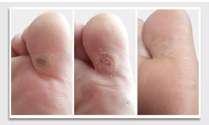 你不得不看的足疣30经典案例