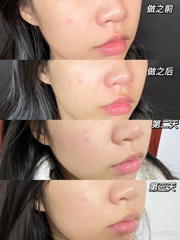 三,光子的治疗效果具体怎么样?