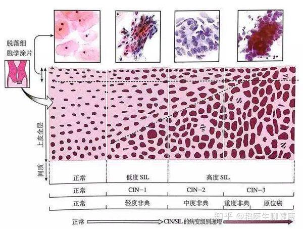 宫颈组织学分层示意图图片